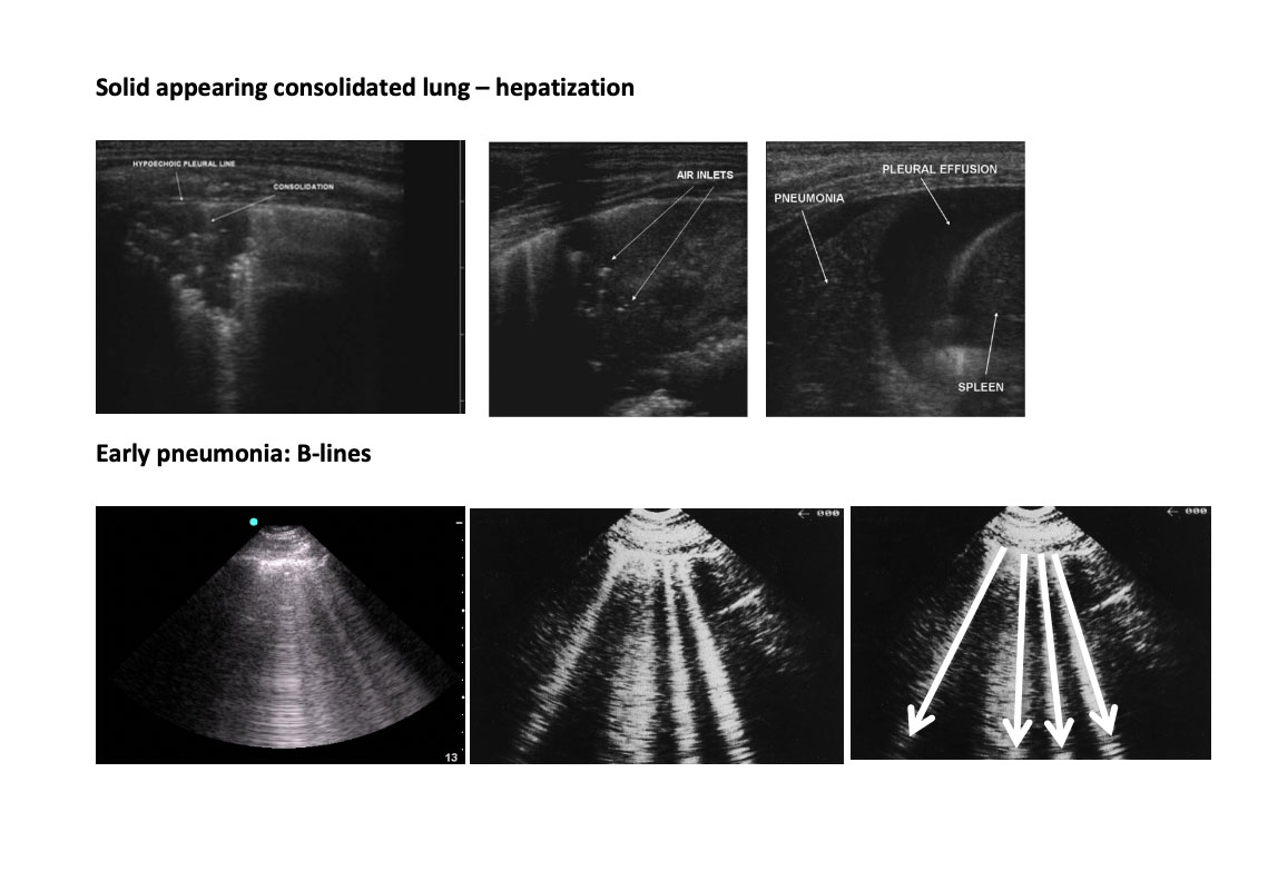 How lung ultrasound is helping clinicians with early diagnosis of Novel Coronavirus (COVID-19) Pneumonia