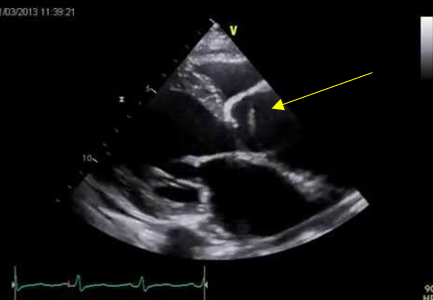 Echocardiography Evaluation of Aortic Dissection