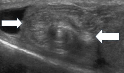 Point-of-Care Ultrasound (POCUS) of the Acute Scrotum - Whirlpool Sign in Testicular Torsion